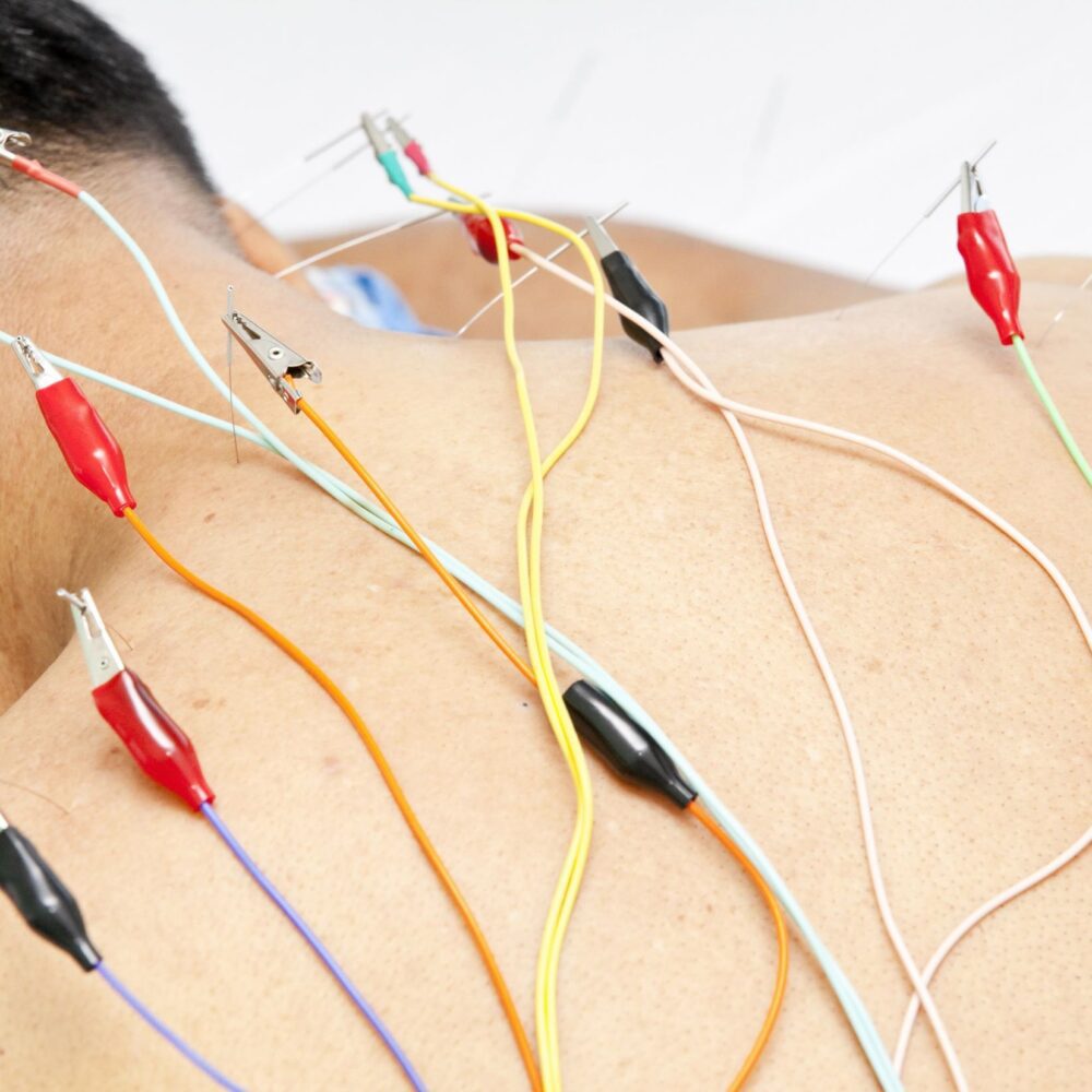 Electronic Acupuncture